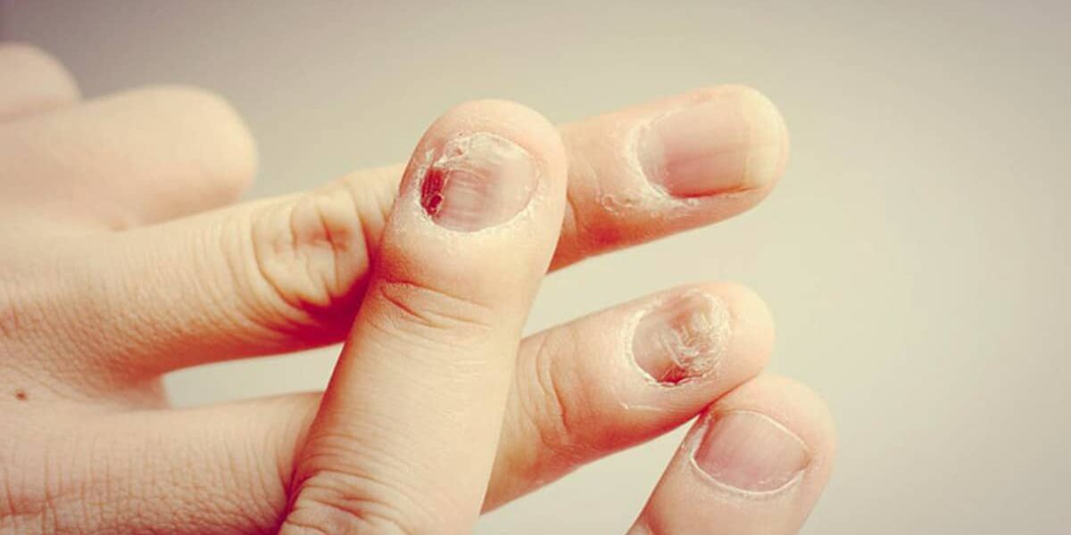 Tác hại khi bị nấm móng và cách điều trị